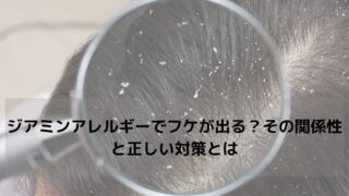 ジアミンアレルギーでフケが出る？その関係性と正しい対策とは