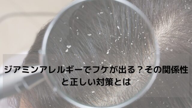 ジアミンアレルギーでフケが出る？その関係性と正しい対策とは